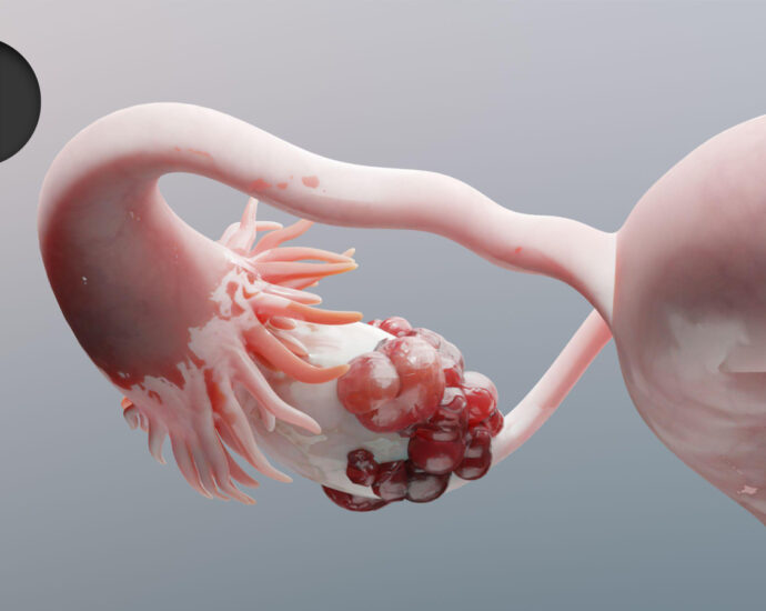 Novel Regimen Boosts Survival for Recurrent Platinum-Resistant Ovarian Cancer