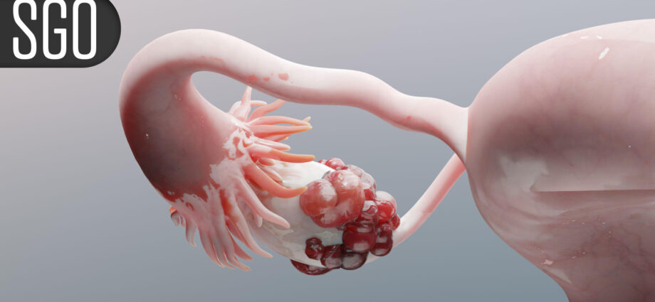 Novel Regimen Boosts Survival for Recurrent Platinum-Resistant Ovarian Cancer