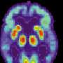 Much-hyped Alzheimer’s drugs removed amyloid yet brought no meaningful gains over 18 months