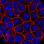 Blocking a cellular inflammation process could result in effective therapy for pancreatic cancer
