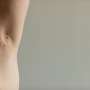 Povorcitinib beneficial for moderate-to-severe hidradenitis suppurativa