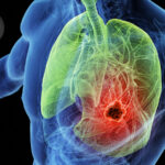 Local Consolidative Therapy After Dual Immunotherapy Fizzles in Metastatic NSCLC