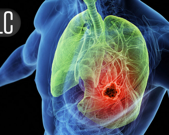 Local Consolidative Therapy After Dual Immunotherapy Fizzles in Metastatic NSCLC