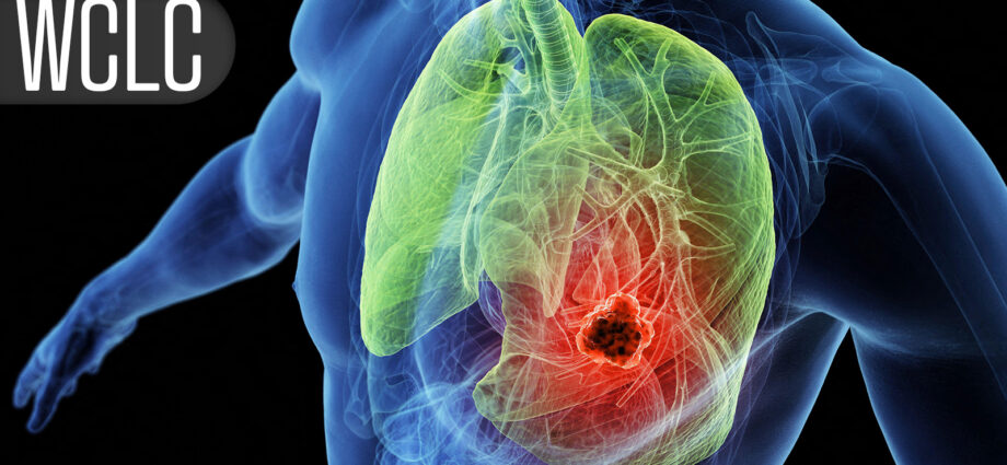 Local Consolidative Therapy After Dual Immunotherapy Fizzles in Metastatic NSCLC